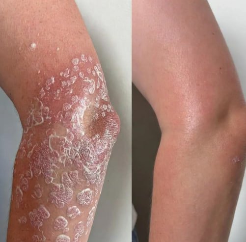 Знищ псоріаз з PsoriaSoothe Bee Rescue Cream